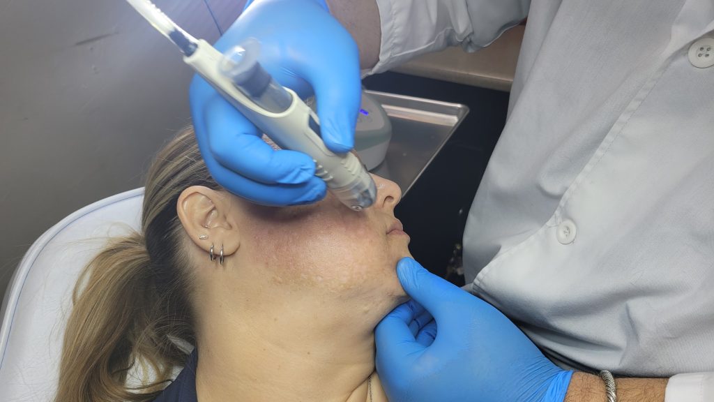 A microneedling treatment at PV MediSpa